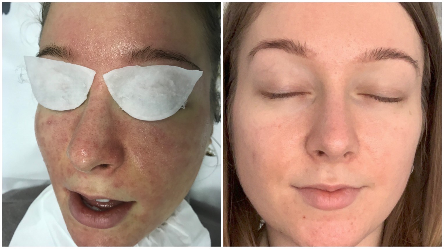 Rosacea kezelése több alkalom