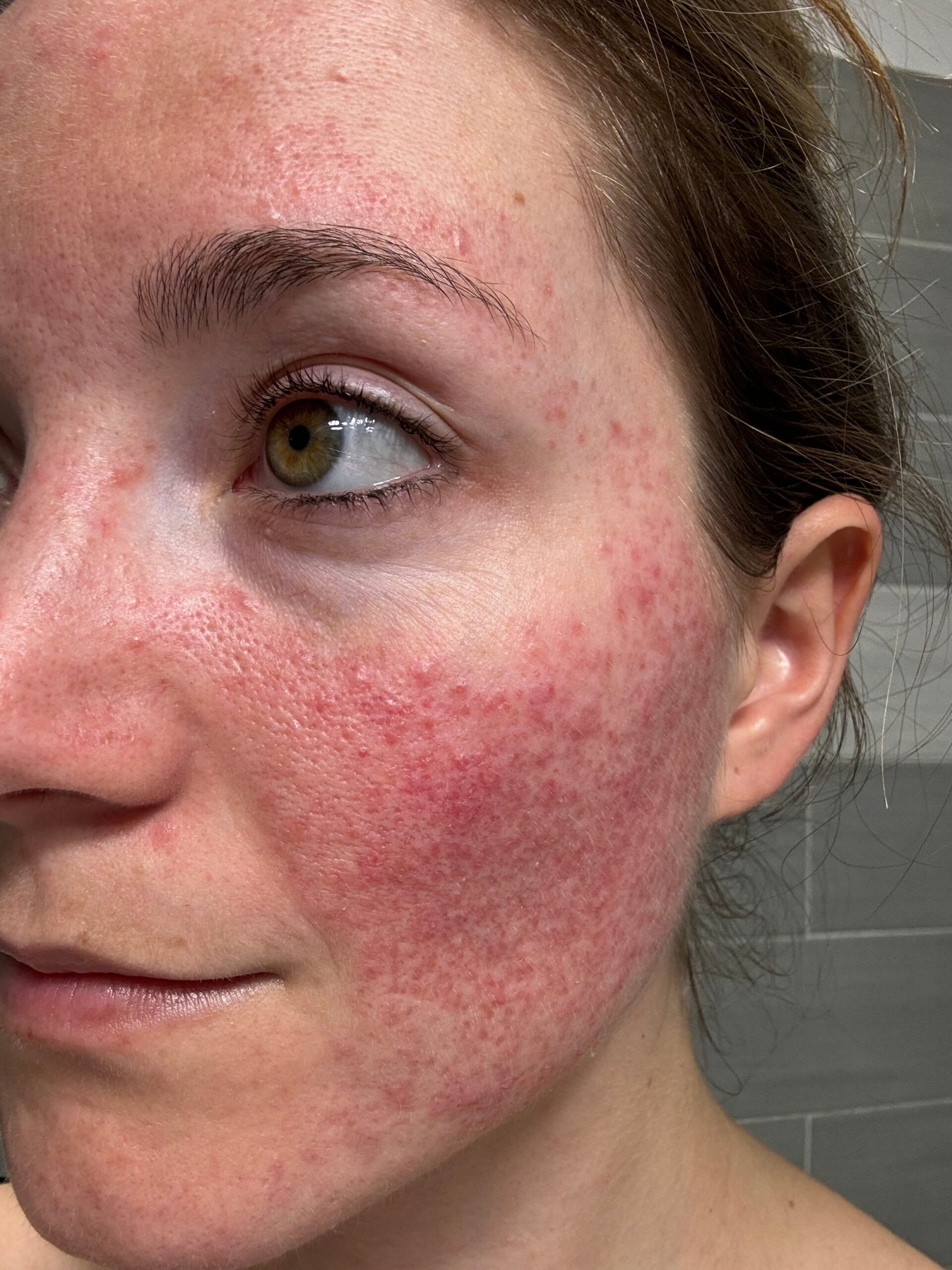 Rosacea előtte