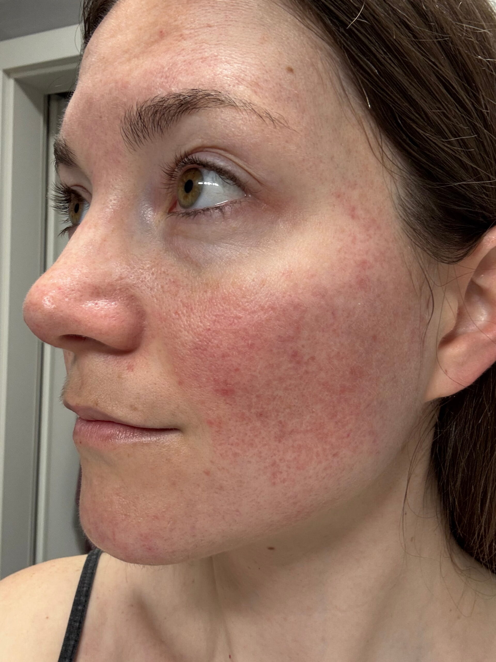 Rosacea utána